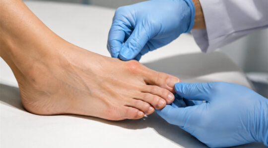Hallux valgus